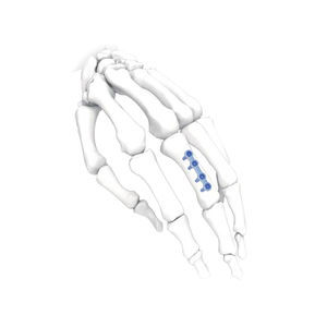 Kompressionsplatte für Hand 1