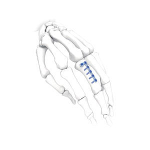 Kompressionsplatte für Hand 1
