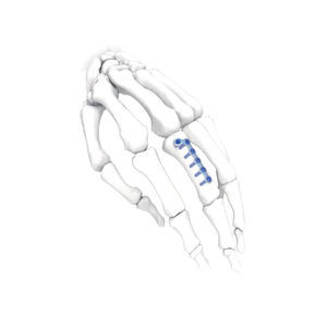 Kompressionsplatte für Hand 1