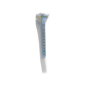 Kompressionsplatte für Tibia 1