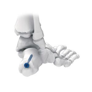 Knochen-Kompressionsschraube / für Calcaneum