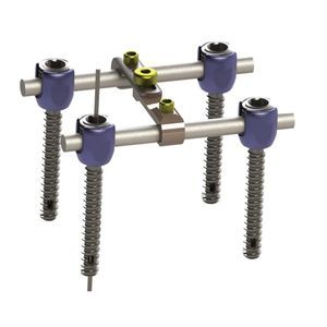 thorako-lumbales Stabilisierungssystem für Osteosynthese