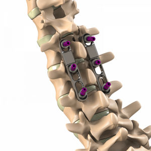 thorako-lumbales Stabilisierungssystem für Osteosynthese