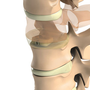 HWS-Zwischenwirbelimplantat