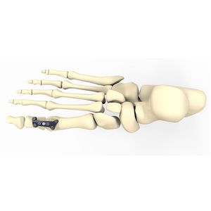 Arthrodeseplatte für Hallux Valgus