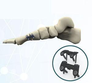Arthrodeseplatte für Hallux Valgus