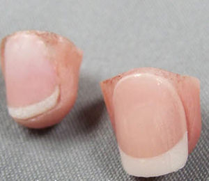 Kosmetische Fingerprothese
