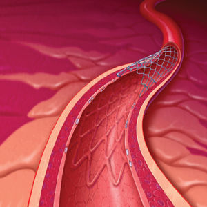 Koronararterien-Stent