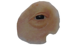 Kosmetische Orbitalprothese