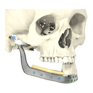 patientenspezifisches Unterkieferimplantat