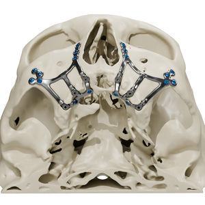 maßgefertigter subperiostales Implantat 1