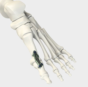 Arthrodeseplatte für Metatarsophalangealgelenk 1