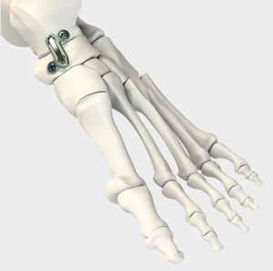 Kavikulargelenksarthrodese-Arthrodeseplatte