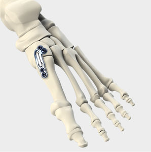 Arthrodeseplatte für tarsal-metatarsales Gelenk