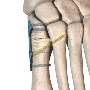 Osteotomieplatte für Hallux Valgus