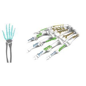 Kompressionsplatte für Fingerglied