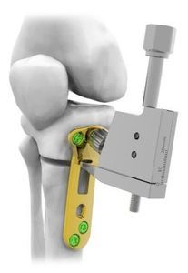 Osteotomieplatte für Tibia