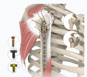 Kompressionsplatte für Humerus 1