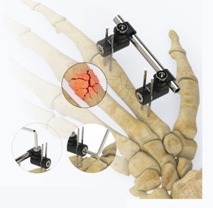 Fixateur externe / für Metatarsophalangealgelenk 1