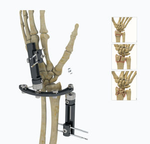 Fixateur externe / für Handgelenk 1