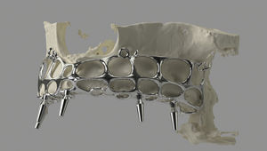 Allograft-Knochenersatzmaterial