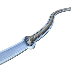 Ureter-Stent 1