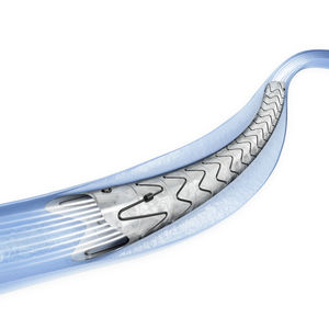 Ureter-Stent 1