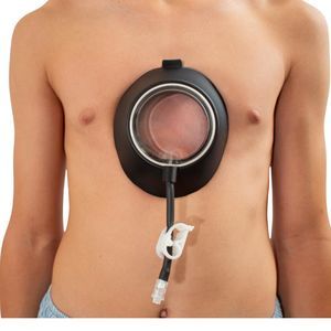 Saugglocke zur Korrektur des Pectus excavatum 1