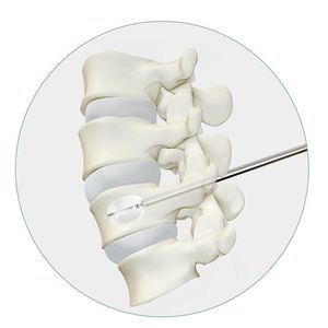 Vertebroplastie-System / Ballonkatheter