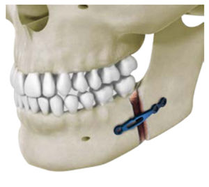 Osteotomieplatte für Unterkiefer