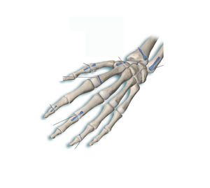 Knochen-Kompressionsschraube für Fingerglied