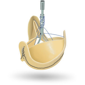 Biologischer Aortenklappenersatz / Aorta 1