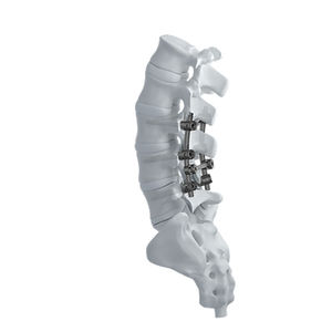 Stabilisierungssystem für Osteosynthese / LWS