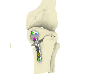 Osteotomieplatte für Tibia