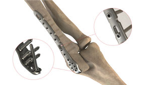 Kompressionsplatte für Ulna 1