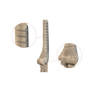 Kompressionsplatte für Humerus 1