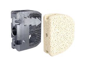 HWS-Zwischenwirbelimplantat 1