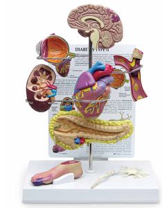 Anatomisches Modell / zur Sensibilisierung für Diabetes