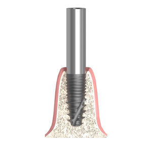 zylindrisches Implantat-Abutment