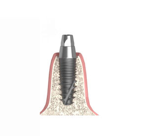 konisches Implantat-Abutment