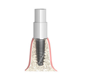 Implantat-Abutment / Konus zylindrisch