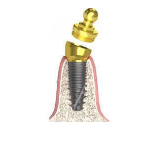 Implantat-Abutment / Konus zylindrisch