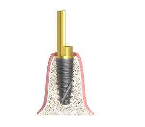 zylindrisches Implantat-Abutment