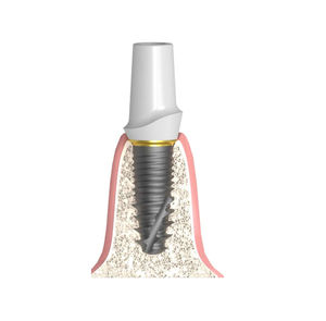 konisches Implantat-Abutment