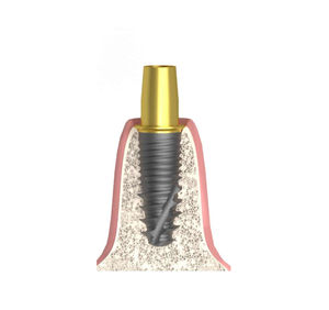 Implantat-Abutment / Konus zylindrisch