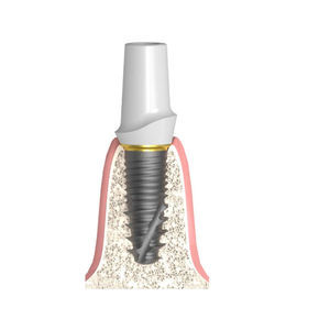 Implantat-Abutment / Konus zylindrisch