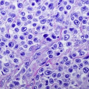 Testkit für Lymphome