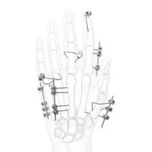Fixateur externe für Fingergrundgelenk 1
