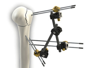 Fixateur externe / für Humerus 1
