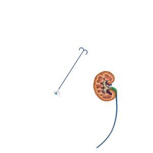 Ureterzugangsschaft